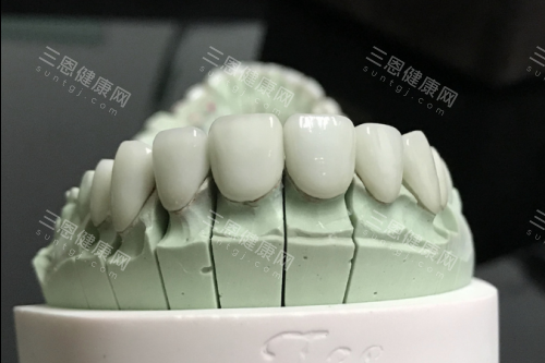 全瓷牙模型展示图 全瓷牙模型展示图