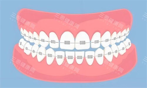金属矫正牙齿 金属矫正牙齿