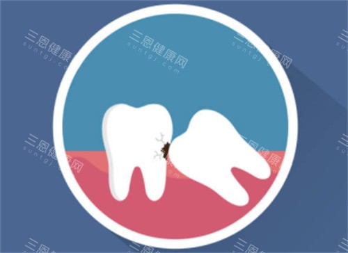 牙齿拥挤示意图 牙齿拥挤示意图