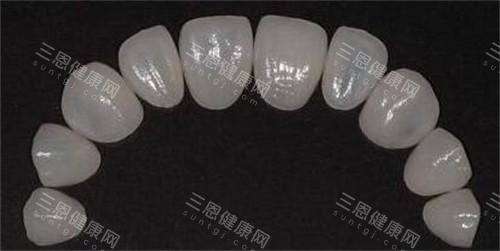 牙贴面修复改善 牙贴面修复改善