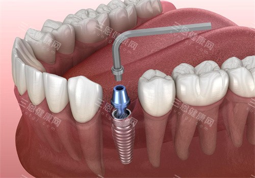 种植牙操作动画图片 种植牙操作动画图片