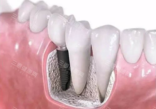 深圳歐雅口腔種植牙掂唔掂？醫生夠晒經驗，種完返屋企就食到飯！