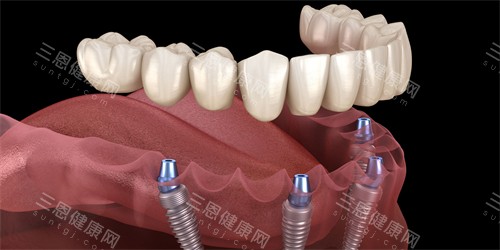 半口种植牙图示