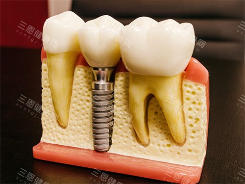 种植牙模型图