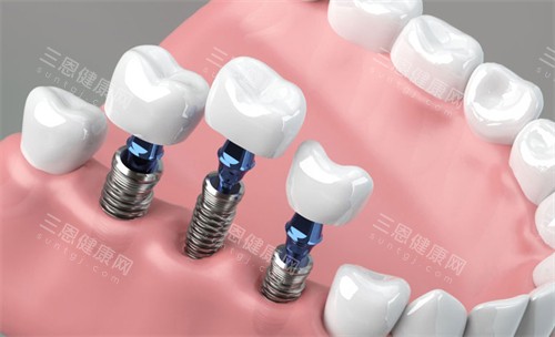 种植牙在口腔内的样子