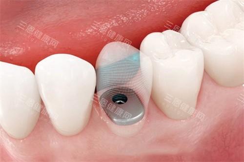 种植牙完成后透视图