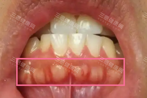牙槽骨增生.webp