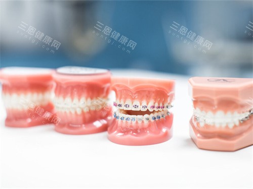 不同的牙齿矫正牙套模型 不同的牙齿矫正牙套模型