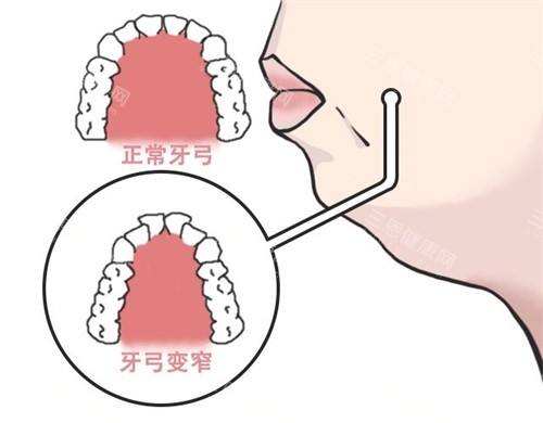 牙齿矫正扩牙弓目的 牙齿矫正扩牙弓目的