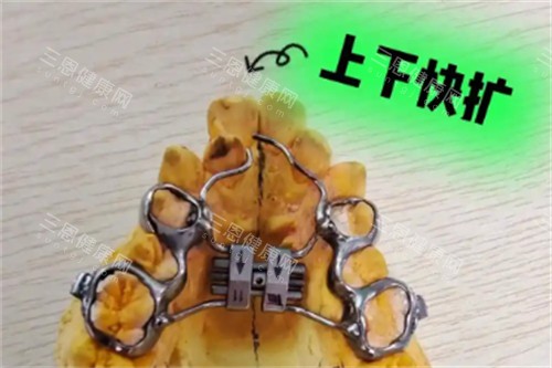 基托式螺旋扩弓器好不好 基托式螺旋扩弓器好不好