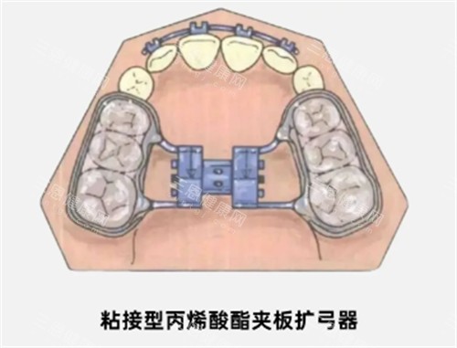 基托式螺旋扩弓器多少钱 基托式螺旋扩弓器多少钱