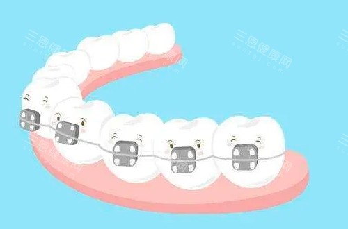 牙齒矯正要拔牙嗎？看牙齒擁擠度，不拔牙矯正適合輕度情況結果好