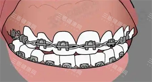 牙齿矫正动画图 牙齿矫正动画图