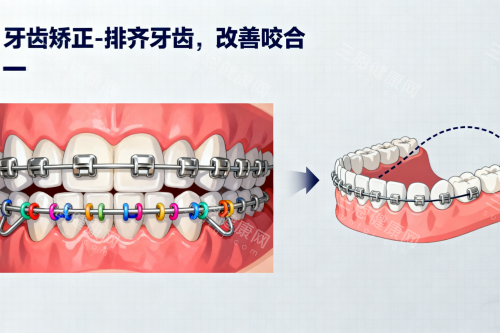金属牙齿矫正卡通展示图