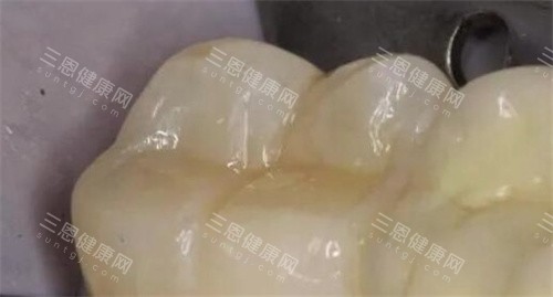 3M树脂补牙
