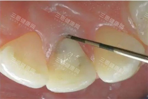 畸形舌侧窝牙齿实例