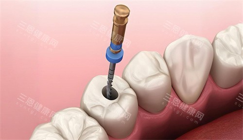 根管治療後一定要戴牙冠？牙醫揭秘保牙關鍵決策！