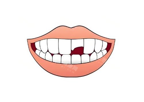 门牙缺损