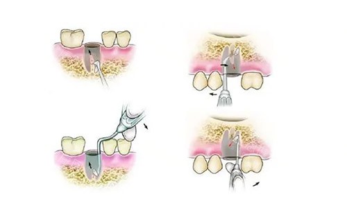 根管治疗示意图 根管治疗示意图