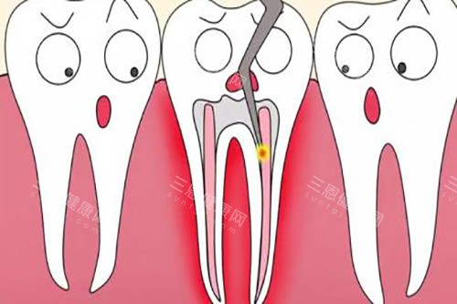 根管治疗卡通 根管治疗卡通