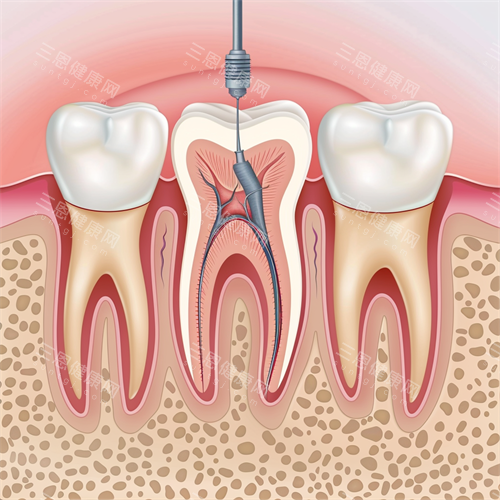 牙齿根管治疗牙髓问题漫画图