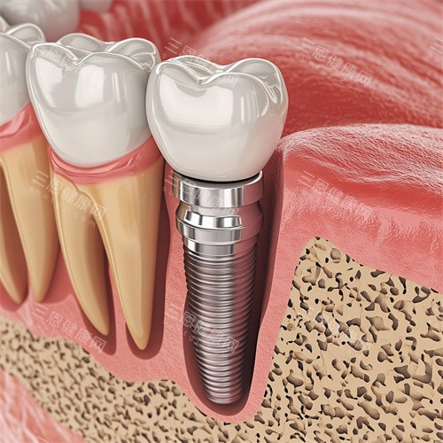 深圳富華(穗華)口腔種植牙真係得！做種植牙技術夠晒專業，仲會清晰講明種牙多少錢，街坊揾佢哋種牙好放心！