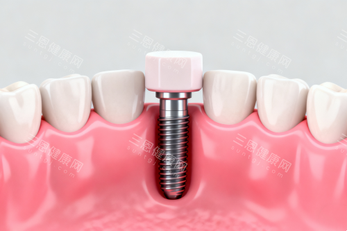种植牙植入口腔模型图 种植牙植入口腔模型图