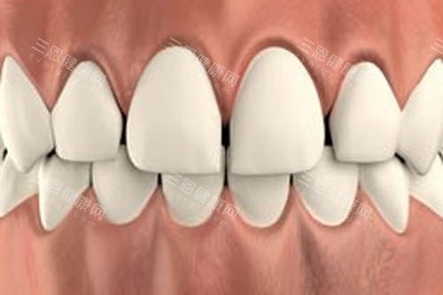 牙齿稀疏示意图