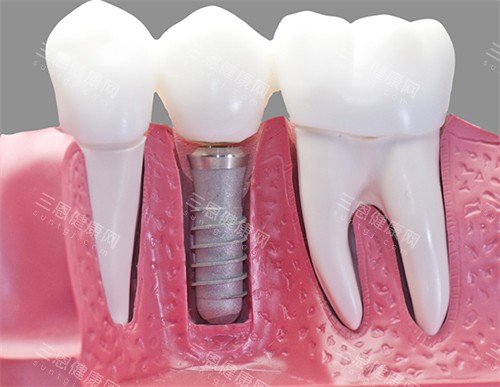 深圳正恩向西院區植牙螺絲評價兩極？過來人話你知優劣勢！