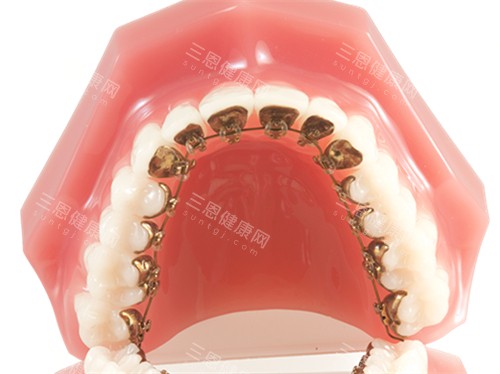 牙齿矫正金属舌侧矫正牙套模型