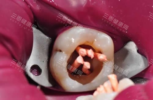 广州根管治疗价格对比香港贵吗？广州多根管2000元起，香港3000港元起，唔同牙位价差竟这么大？