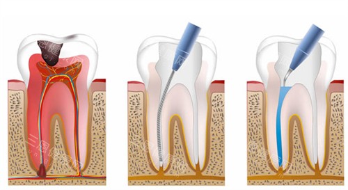根管治疗流程图