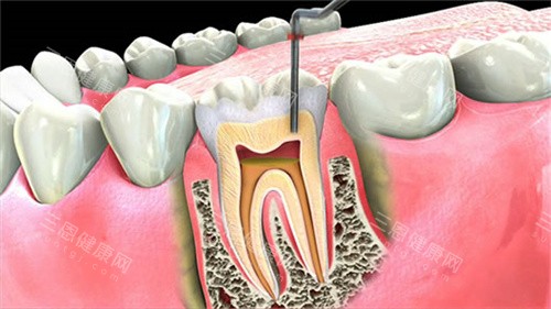 牙齿根管治疗截面图