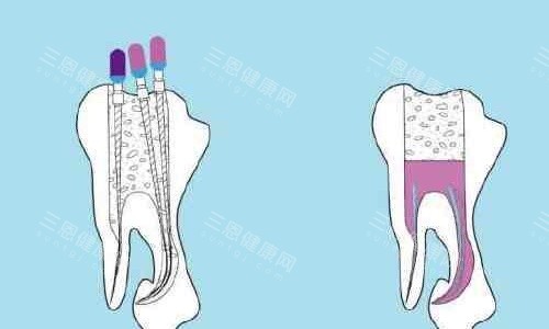 根管治疗手术示意图